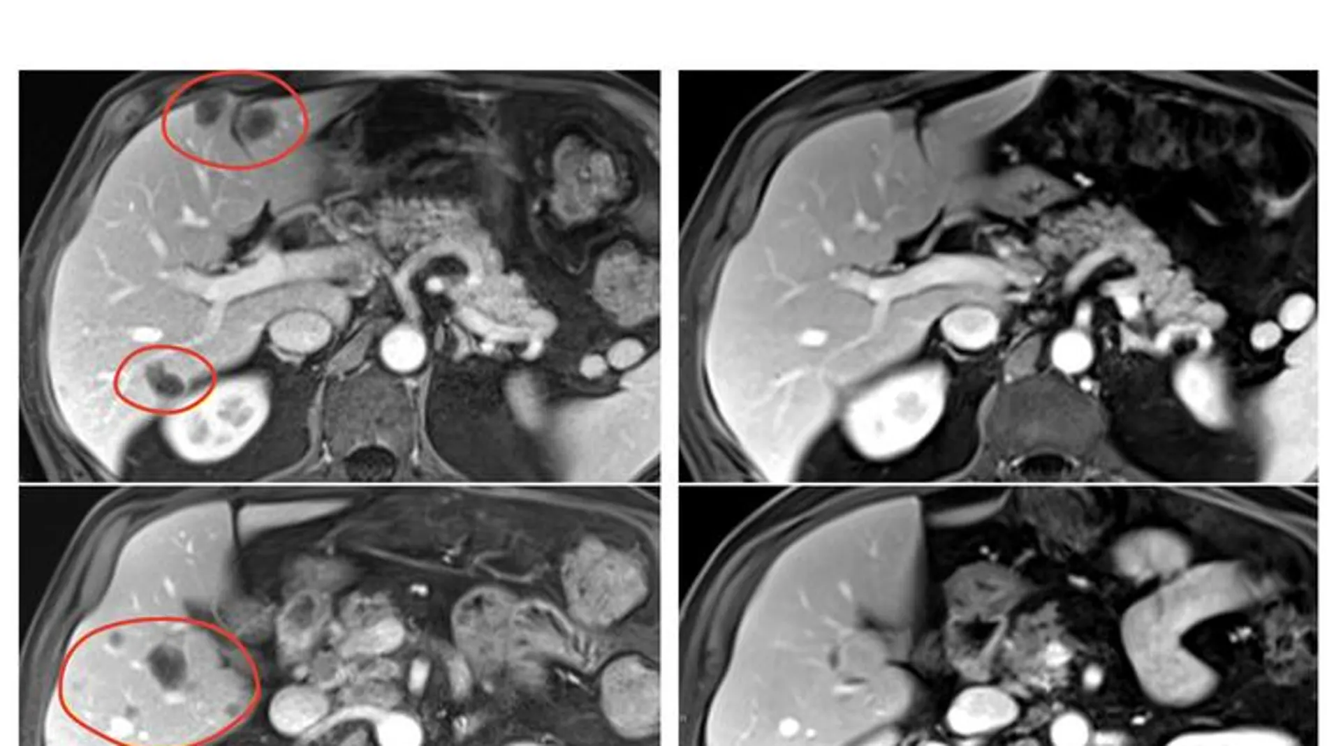 Diez meses después del tratamiento con terapia TIL seleccionada y pembrolizumab, un paciente con cáncer de recto presentó una reducción significativa de múltiples metástasis hepáticas (escaneos de la izquierda, marcados en rojo)