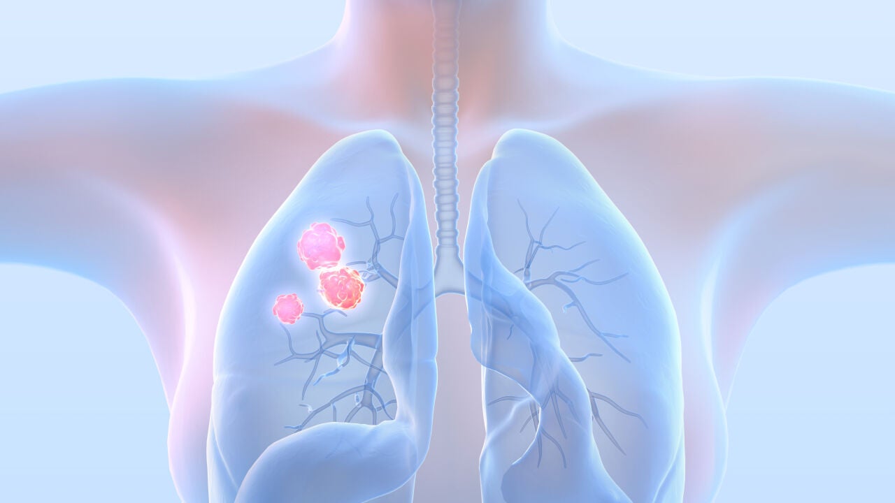 Gender & Lung Cancer: A Perspective - News Directory 3