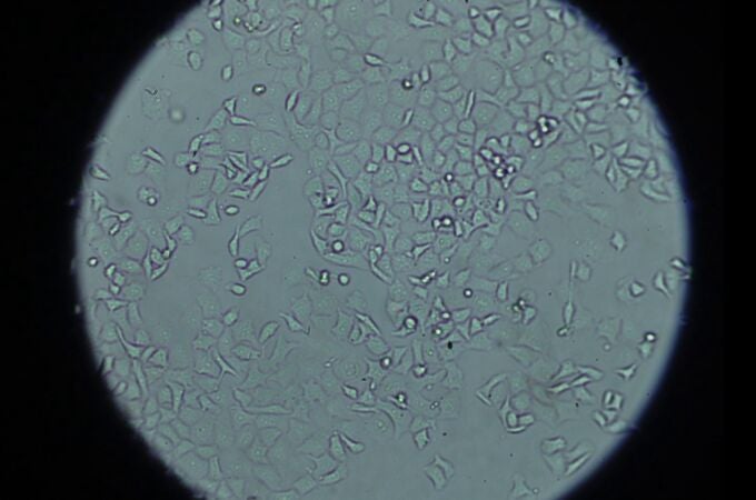 Células de cáncer de páncreas vistas al microscopio en el laboratorio de Anatomía Patológica del 12 de Octubre