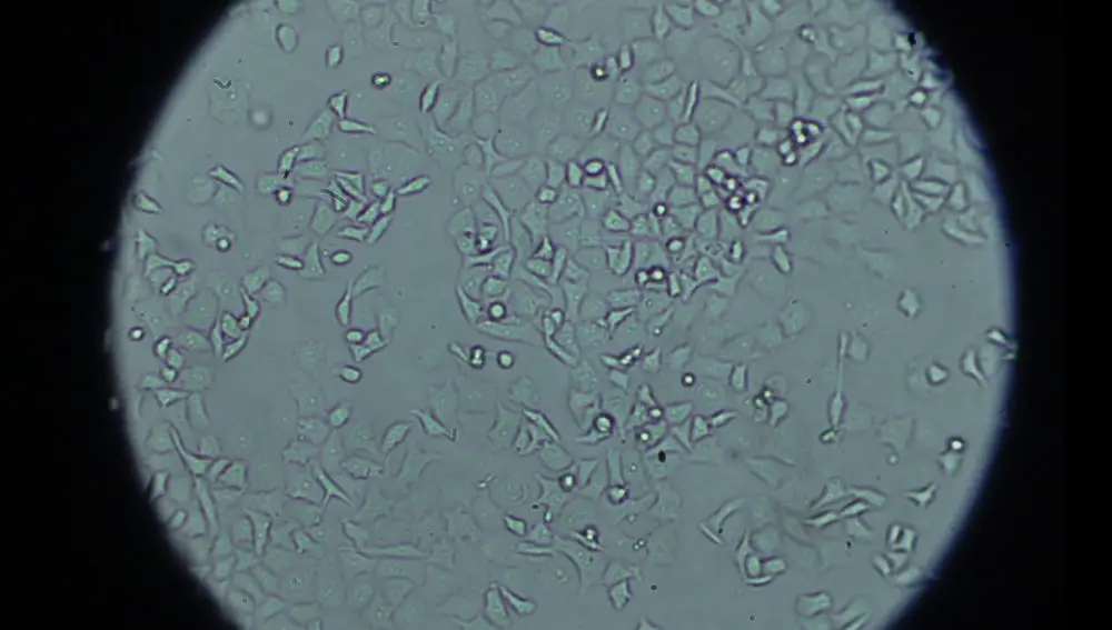 Células de cáncer de páncreas vistas al microscopio en el laboratorio de Anatomía Patológica del 12 de Octubre