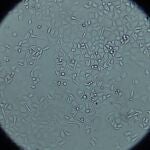 Células de cáncer de páncreas vistas al microscopio en el laboratorio de Anatomía Patológica del 12 de Octubre