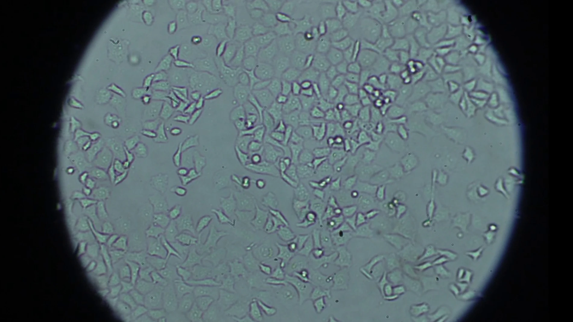 células de cáncer de páncreas vistas al microscopio en el laboratorio de Anatomía Patológica del 12 de Octubre