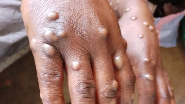 Mpox