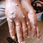 Mpox
