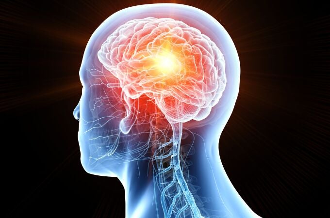 La metástasis cerebral ocurre cuando un cáncer de otra parte del cuerpo se propaga al cerebro