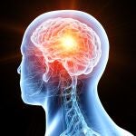 La metástasis cerebral ocurre cuando un cáncer de otra parte del cuerpo se propaga al cerebro