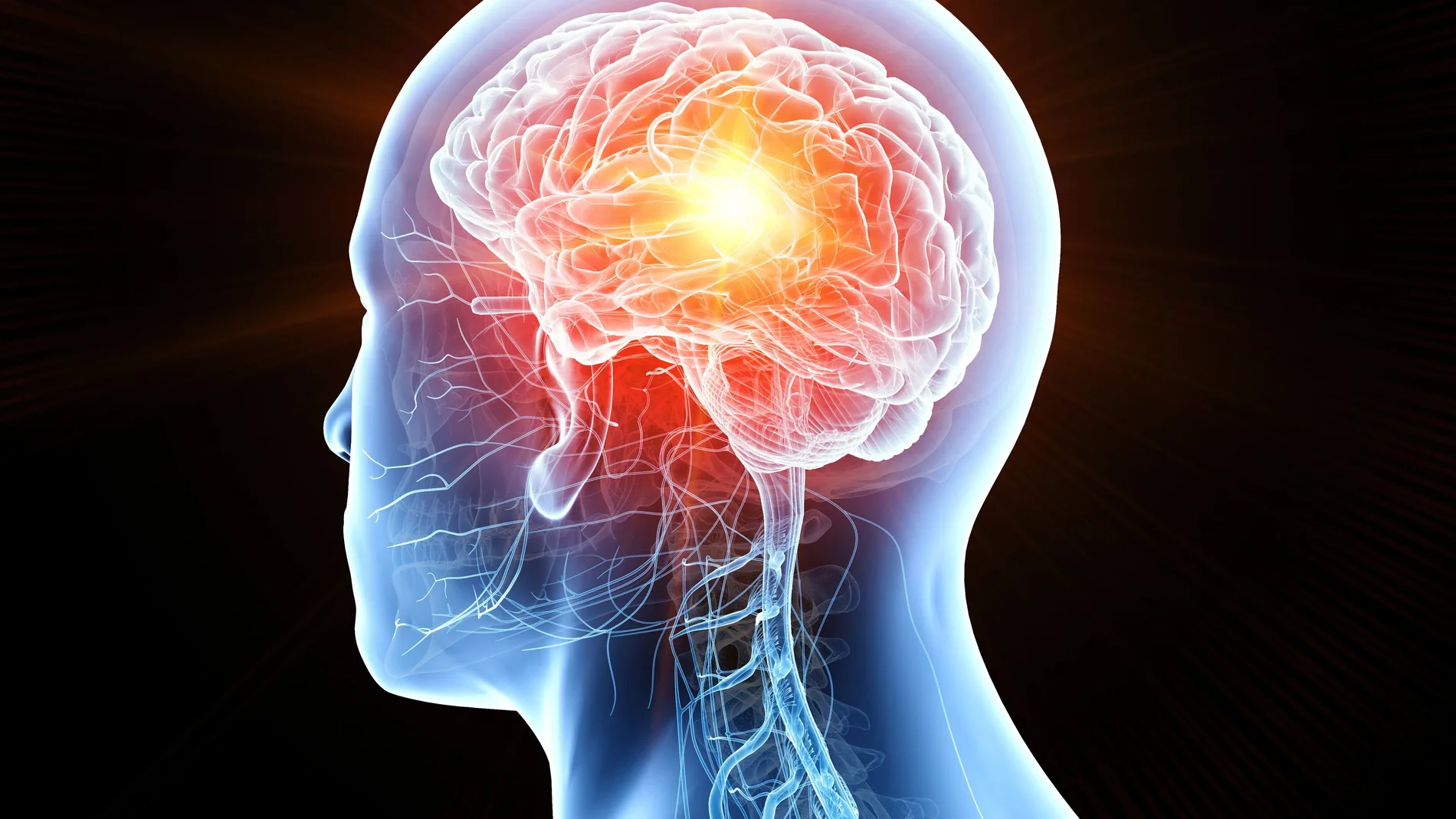 La metástasis cerebral ocurre cuando un cáncer de otra parte del cuerpo se propaga al cerebro