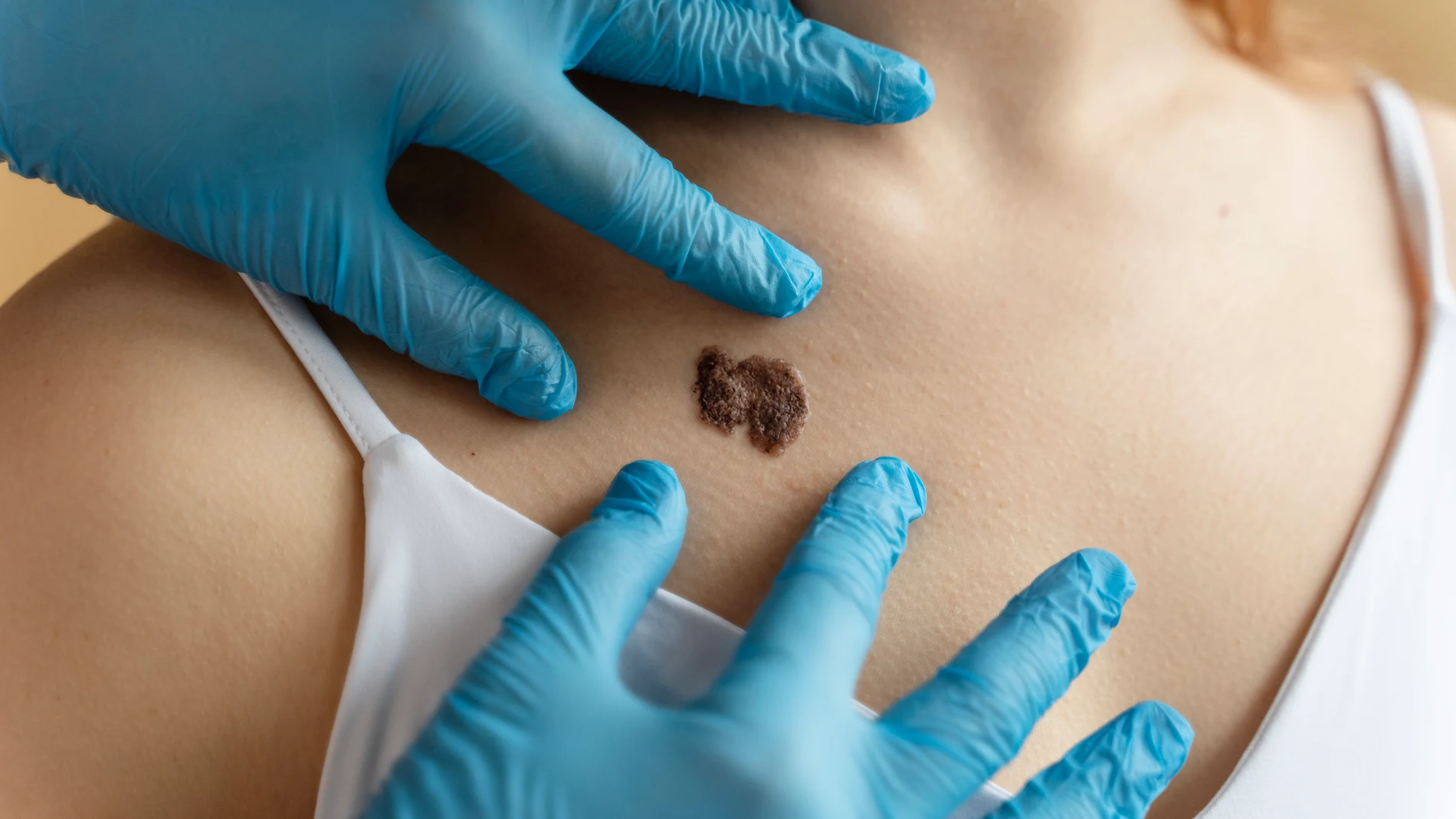 Lunar en el cuello y pecho que podría indicar cáncer de piel