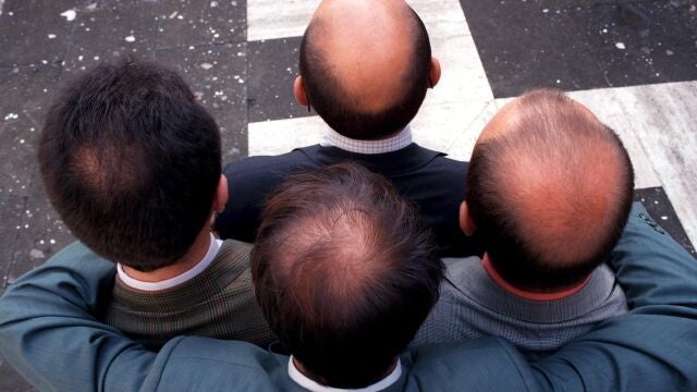 La alopecia afecta hasta al 80% de la población masculina a lo largo de su vida