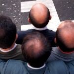 La alopecia afecta hasta al 80% de la población masculina a lo largo de su vida