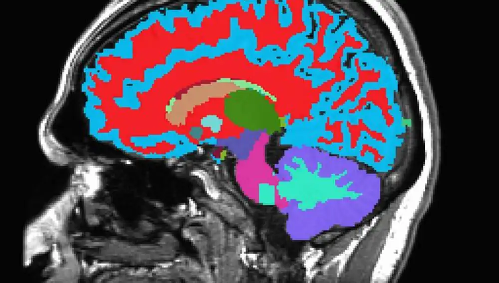 Un escáner cerebral permite saber a qué velocidad envejece una persona