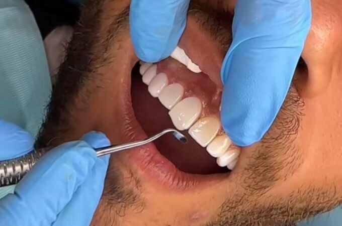 Un dentista realiza un tratamiento dental a un paciente