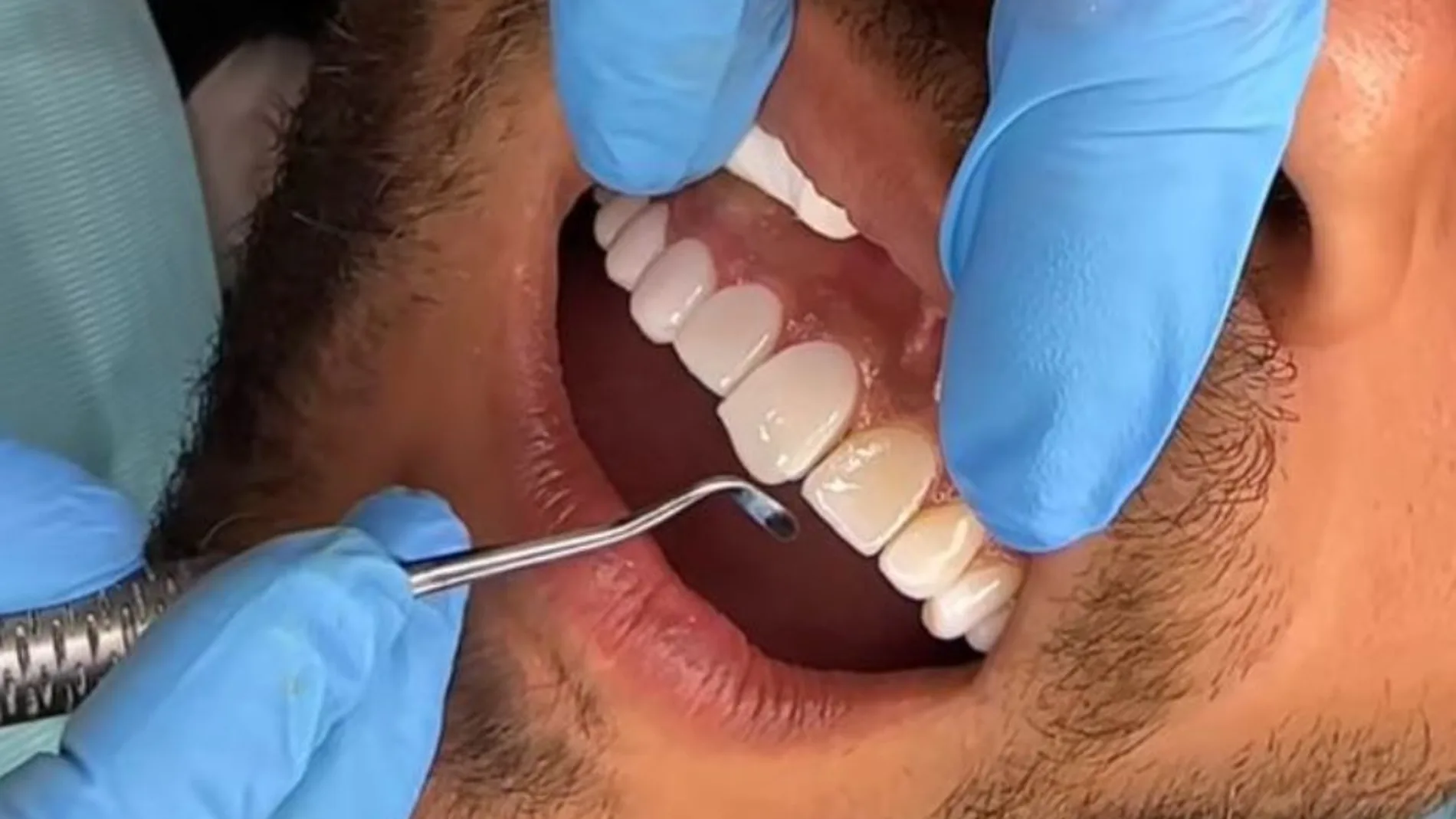 Un dentista realiza un tratamiento dental a un paciente