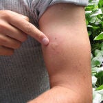 ¿Qué insecto me ha picado? Así lucen las diferentes picaduras