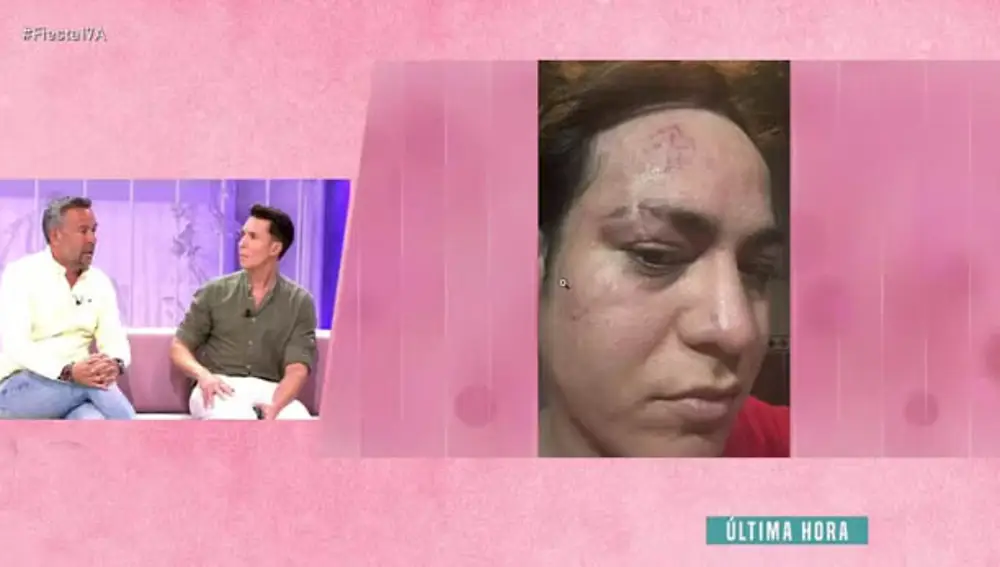 Valeri Cuéllar tras la agresión