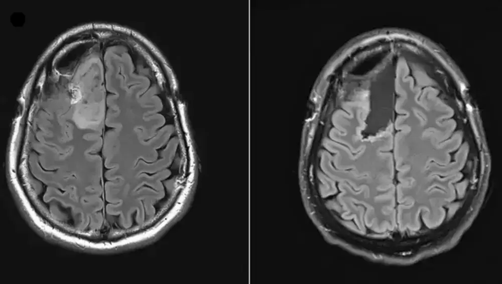 Imágenes cerebrales de un paciente en el primer ensayo clínico mundial donde los investigadores pudieron comparar muestras tumorales tomadas antes del tratamiento (izquierda) y después del mismo (derecha)